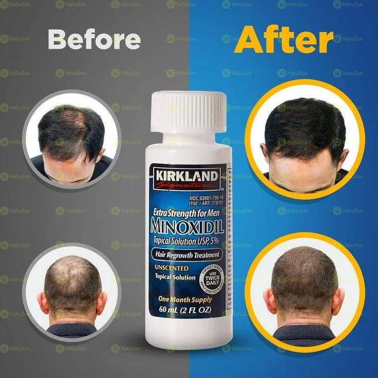 Minoxidil Hair Growth Treatment