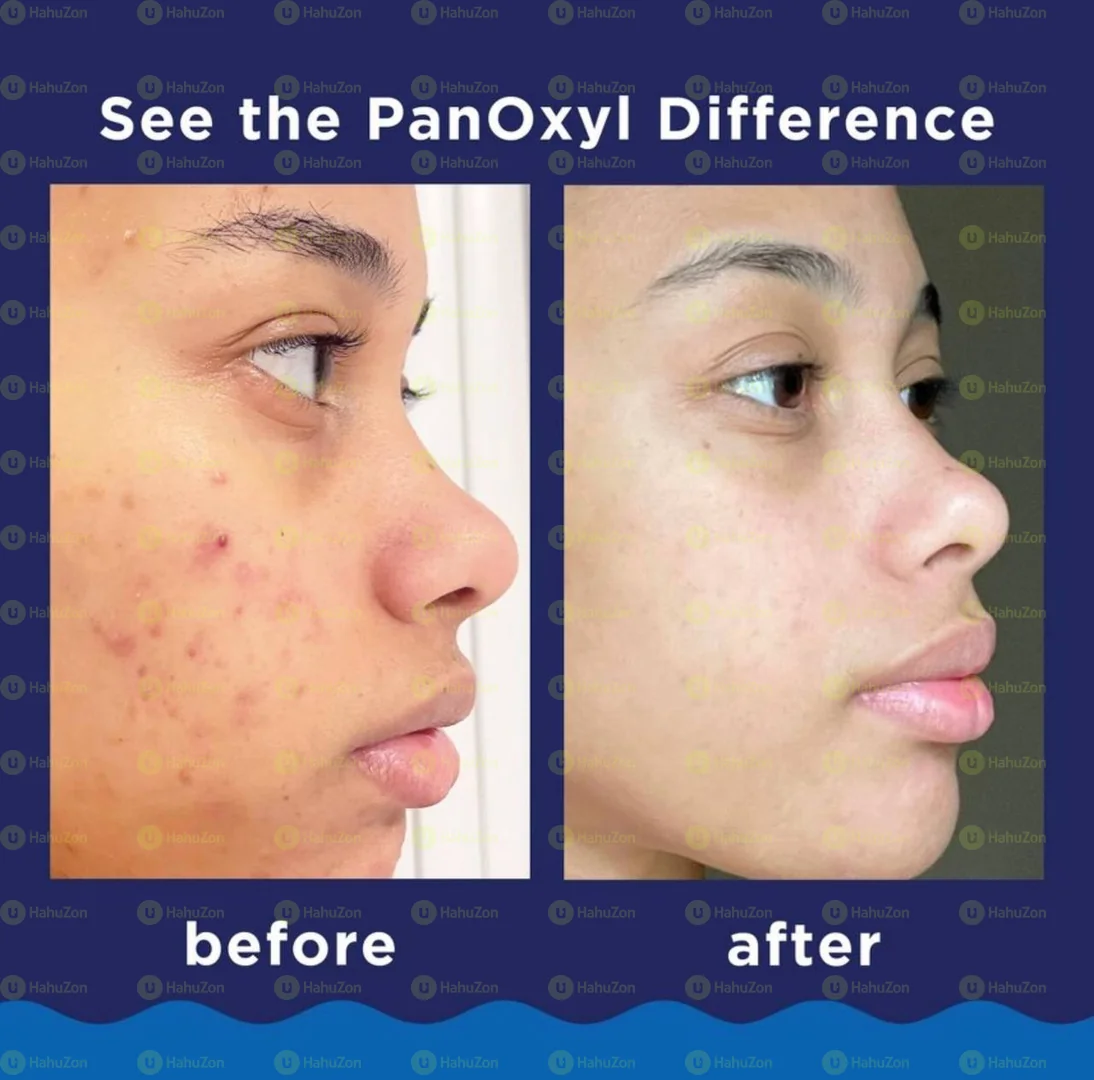 PanOxyl Maximum Strength Acne Foaming Wash