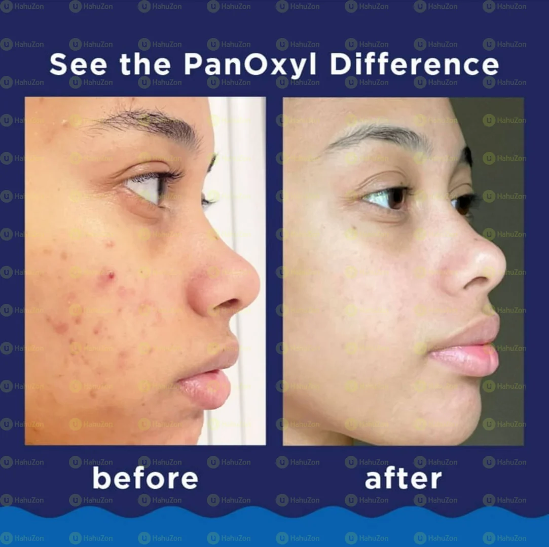 PanOxyl Foaming Acne Wash, 10% Benzoyl Peroxide