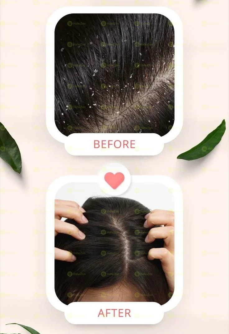 Nizoral Anti-Dandruff Shampoo